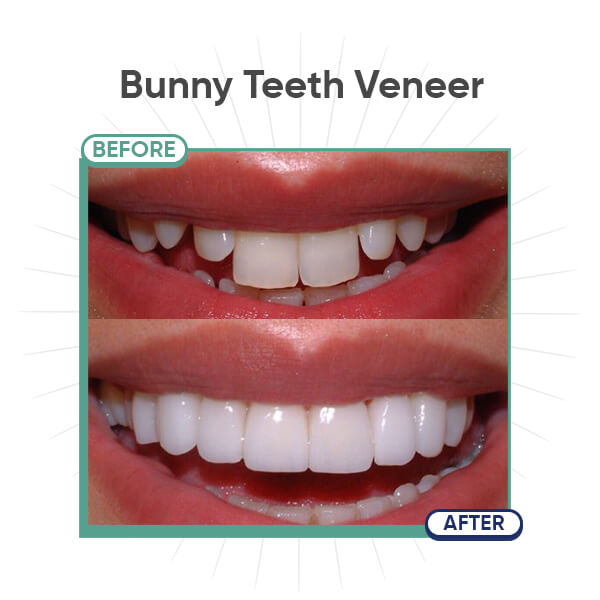 Bunny Teeth Veneer