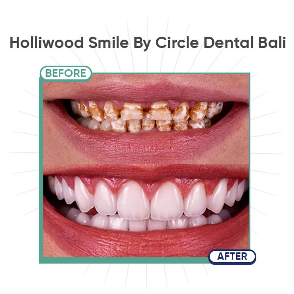 Holliwood Smile By Circle Dental Bali