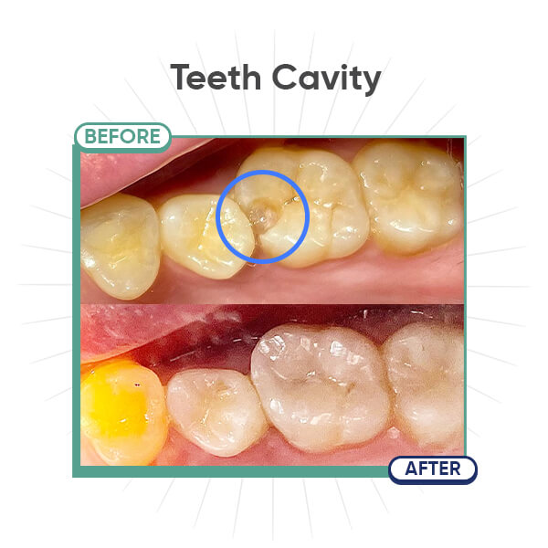 Tooth Cavity