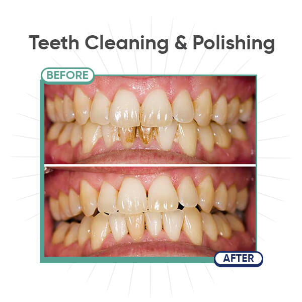 Teeth Cleaning & Polishing