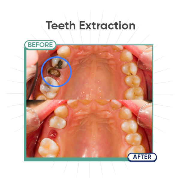 Tooth Extraction 