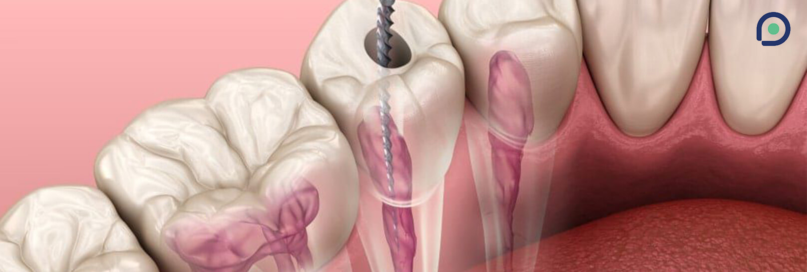 Treatment root canal pada gigi